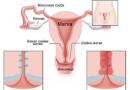 Viêm nội tiết cổ tử cung phát triển như thế nào?